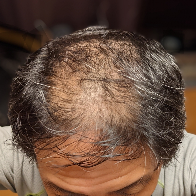 頭頂部の薄毛の原因とは？