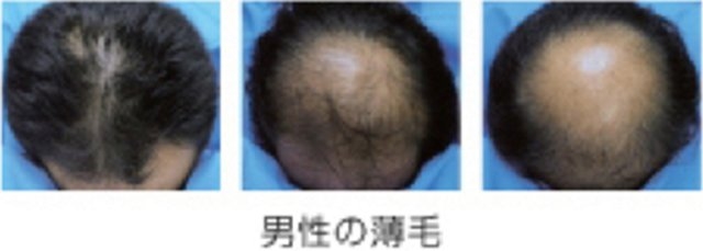 男性の薄毛について