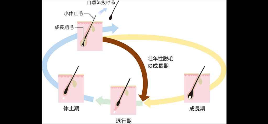 男性の薄毛について
