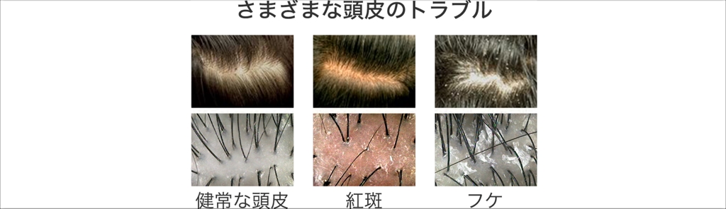 頭皮のトラブルは何故起きる？